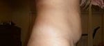 before my tummy tuck side view